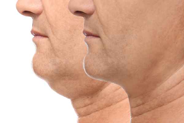 HIFU - Breakthrough in Anti - ageing 2 hifu results Newmarket