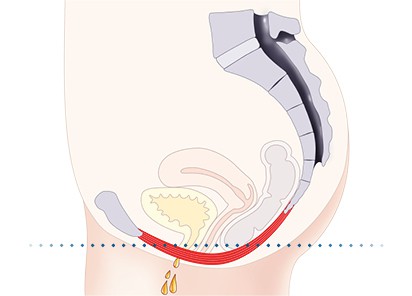 Pelvic-Floor Muscle Repair 5 Pelvic floor muscles Newmarket