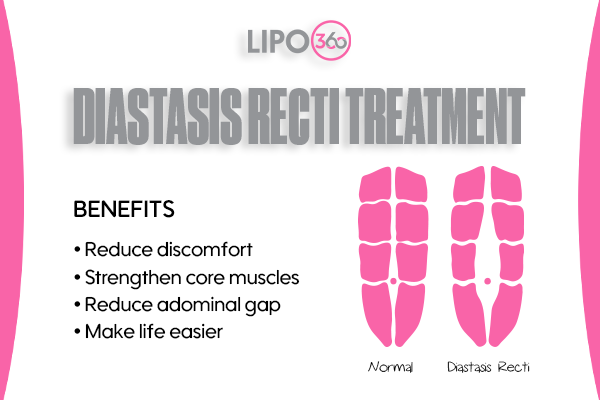 Revolutionising Muscle Repair: The Power of LIPO360 Body Sculpt Post-Injury 5 diastasis recti treatment Newmarket