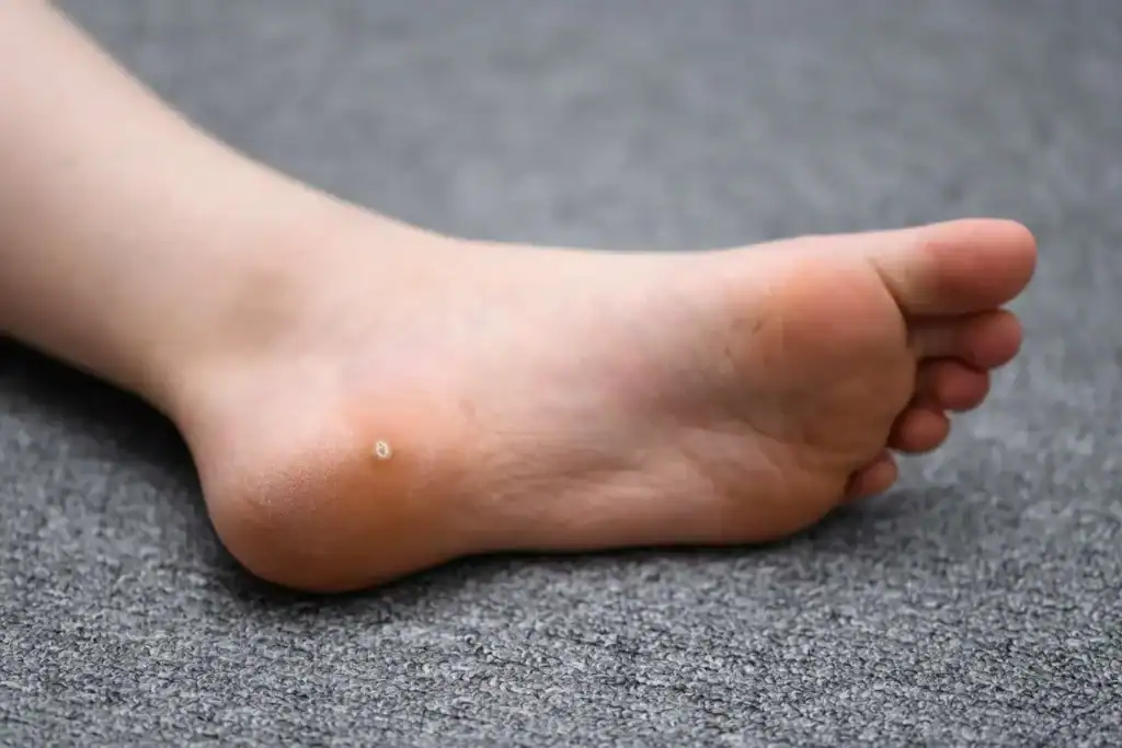 Cryotherapy For Warts And Also Verrucas 2 Image of verruca on the bottom of the foot that able to be treated with Cryotherapy Newmarket