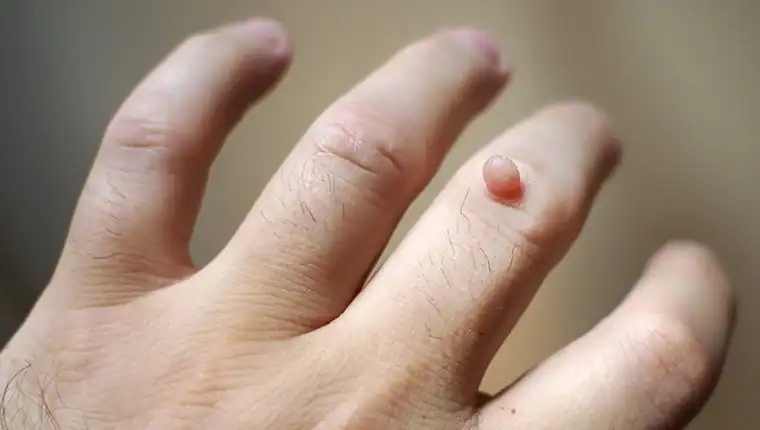 Cryotherapy For Warts And Also Verrucas 1 Image of blemish that Cryotherapy Newmarket can remove with Lipo 360.