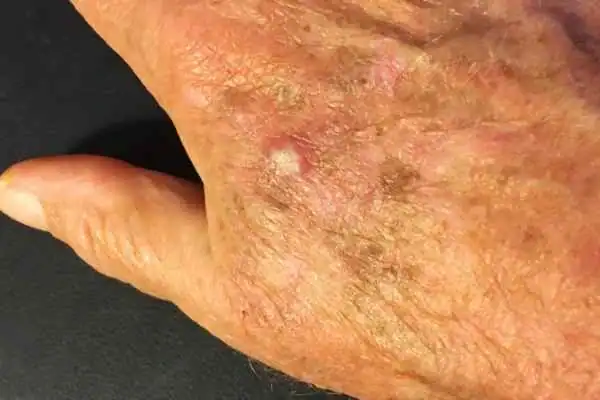 Cryopen For Actinic Keratoses 1 Image of Actinic keratoses Newmarket on a person hand