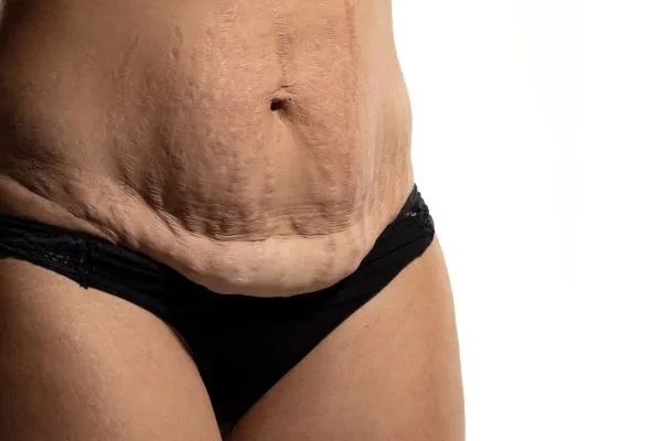 The Science of Skin Tightening 1 The science behind skin tightening Newmarket picture of a woman's sagging skin on the stomach